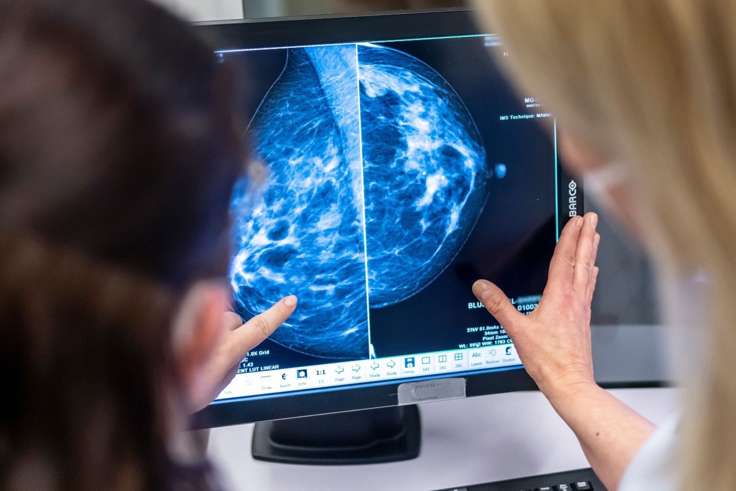 Bei Frauen ist Brustkrebs die verbreitetste Form von Krebs.